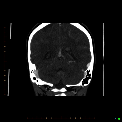 Cerebral arteriovenous malformation (AVM) (Radiopaedia 78162-90706 Coronal CTA 35).jpg