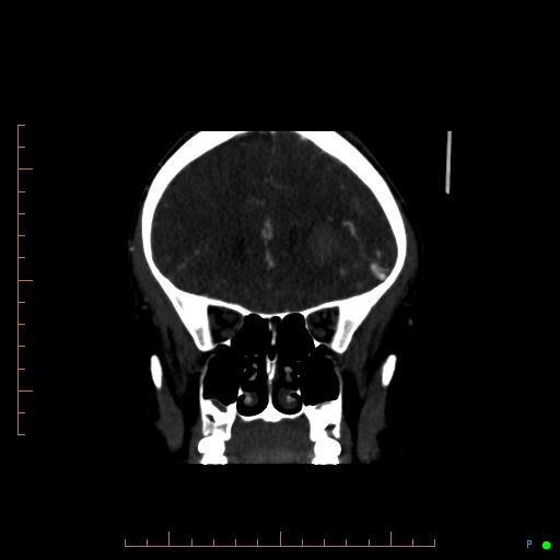 Cerebral arteriovenous malformation (AVM) (Radiopaedia 78162-90706 Coronal CTA 73).jpg