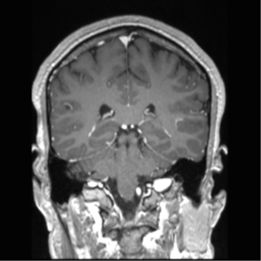 Cerebral arteriovenous malformation (Radiopaedia 39259-41506 Coronal T1 C+ 38).png