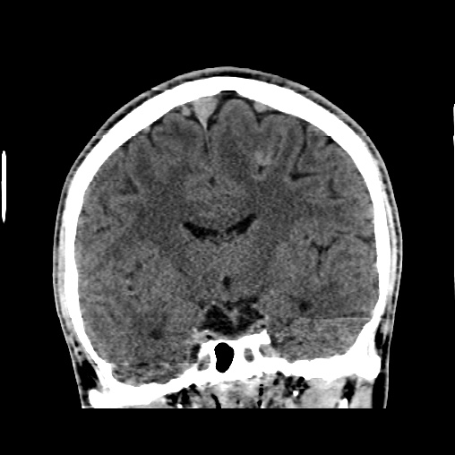 File:Cerebral arteriovenous malformation (Radiopaedia 61964-70028 Coronal non-contrast 30).jpg
