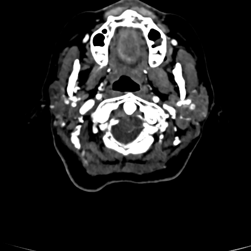 Cerebral arteriovenous malformation (Radiopaedia 73830-84645 Axial C+ delayed 91).jpg