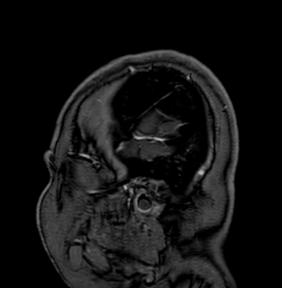 Cerebral arteriovenous malformation (Radiopaedia 74411-85746 Sagittal T1 C+ 3).jpg