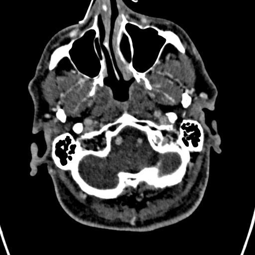 Cerebral arteriovenous malformation (Radiopaedia 78188-90746 Axial C+ delayed 19).jpg