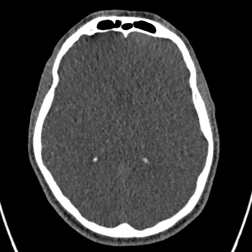 Cerebral arteriovenous malformation (Radiopaedia 78188-90746 Axial non-contrast 93).jpg