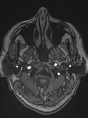 Cerebral arteriovenous malformation (Radiopaedia 84015-99245 Axial TOF 23).jpg