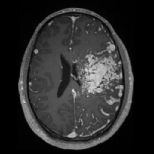 Cerebral arteriovenous malformation - huge (Radiopaedia 35734-37272 Axial T1 C+ 45).png