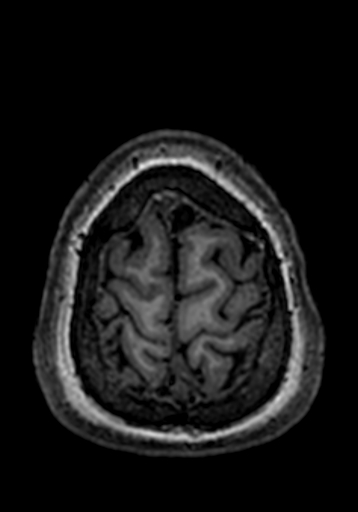 Cerebral arteriovenous malformation at posterior body of corpus callosum (Radiopaedia 74111-84925 Axial T1 13).jpg