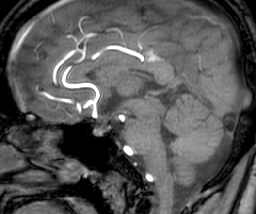 Cerebral arteriovenous malformation at posterior body of corpus callosum (Radiopaedia 74111-84925 J 198).jpg