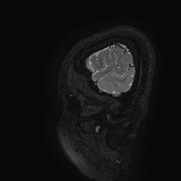 Cerebral arteriovenous malformation at posterior body of corpus callosum (Radiopaedia 74111-84925 Sagittal T2 134).jpg
