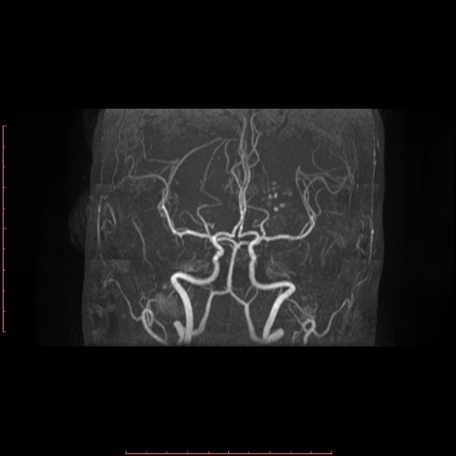 File:Cerebral cavernous malformation (Radiopaedia 26177-26306 MRA 11).jpg