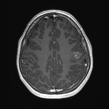 Cerebral cavernous venous malformation (Radiopaedia 70008-80021 Axial T1 C+ 66).jpg