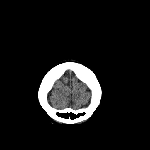 Cerebral cavernous venous malformation (Radiopaedia 70008-80022 non-contrast 5).jpg