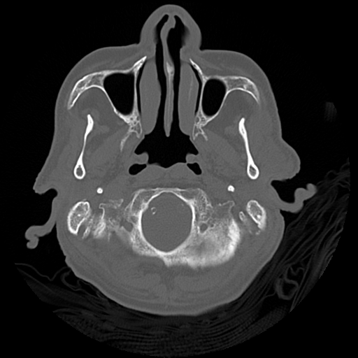 Cerebral contusions, subarachnoid hemorrhage and subdural hygromas (Radiopaedia 55399-61827 Axial bone window 6).png