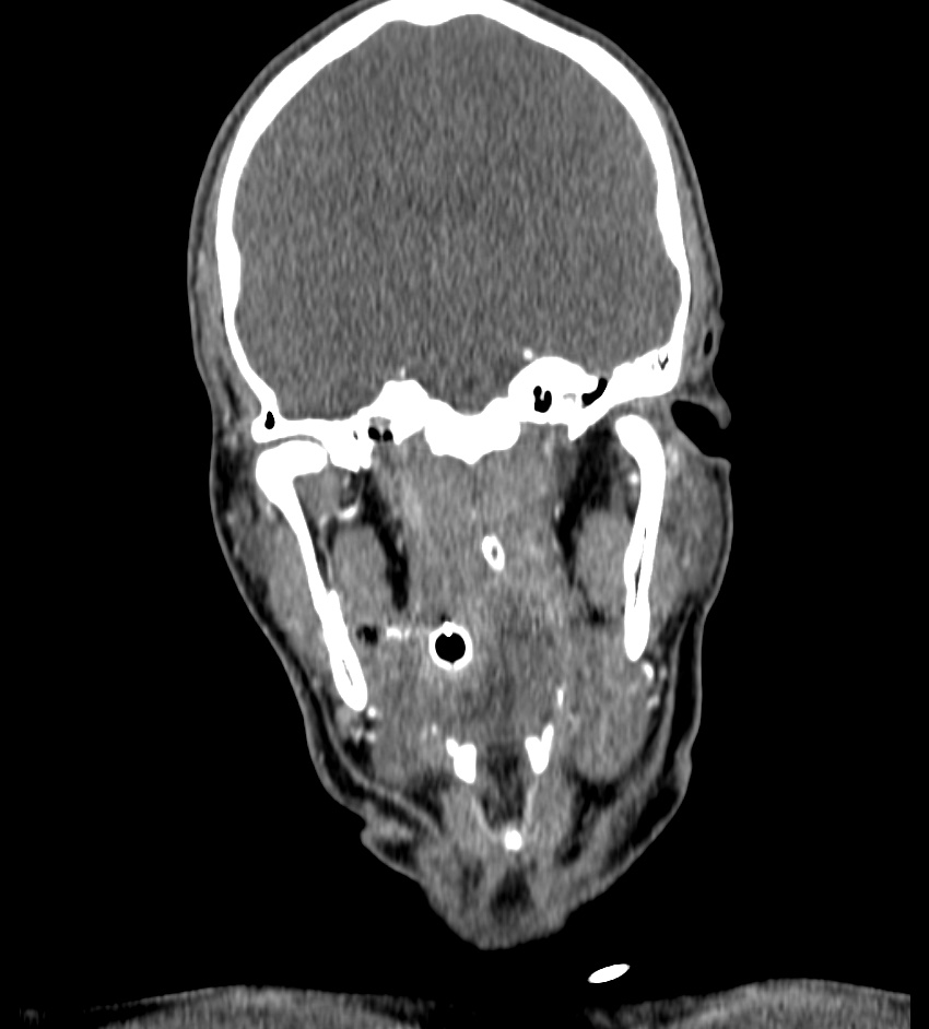 Cerebral edema in an overdose patient (Radiopaedia 72005-82539 B 46).jpg