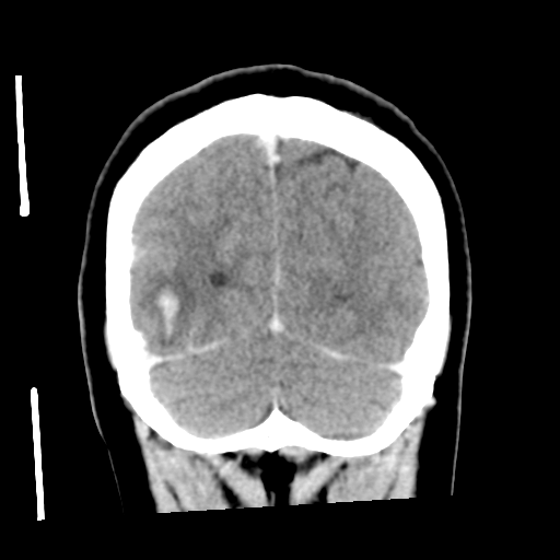 File:Cerebral hemorrhage secondary to arteriovenous malformation (Radiopaedia 33497-34561 C 55).png