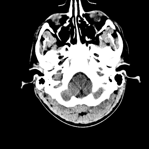 File:Cerebral hemorrhagic contusions- temporal evolution (Radiopaedia 40224-42753 Axial non-contrast 4).png