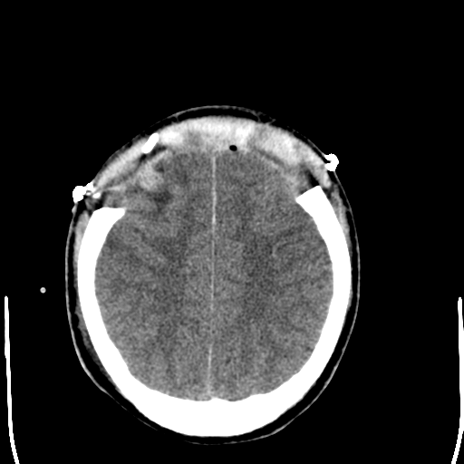 File:Cerebral hemorrhagic contusions- temporal evolution (Radiopaedia 40224-42755 AXIAL THICK 24).png
