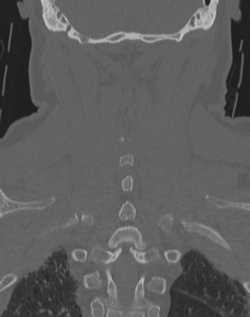 Cerebral hemorrhagic contusions and cervical spine fractures (Radiopaedia 32865-33841 Coronal bone window 57).jpg