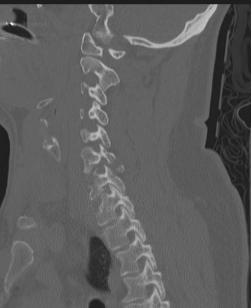 Cerebral hemorrhagic contusions and cervical spine fractures (Radiopaedia 32865-33841 Sagittal bone window 61).jpg