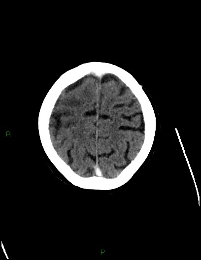 Cerebral metastases - ependymal and parenchymal (Radiopaedia 79877-93131 Axial C+ delayed 69).jpg
