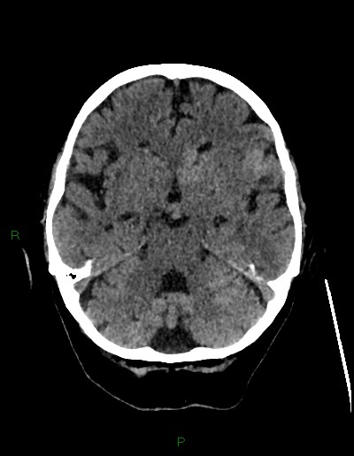 File:Cerebral metastases - ependymal and parenchymal (Radiopaedia 79877-93131 Axial non-contrast 24).jpg