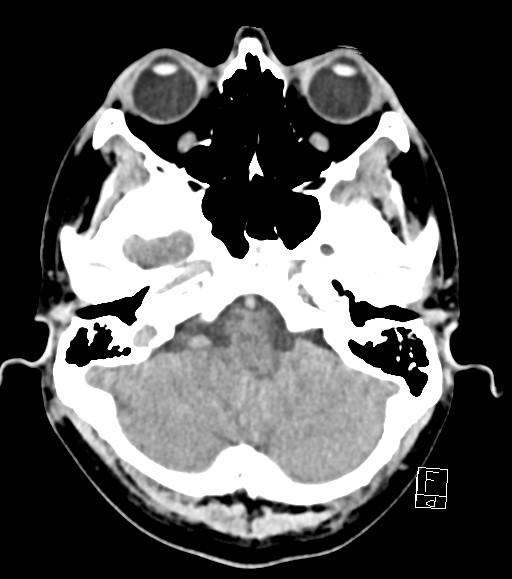 Cerebral metastases - testicular choriocarcinoma (Radiopaedia 84486-99855 Axial non-contrast 44).jpg