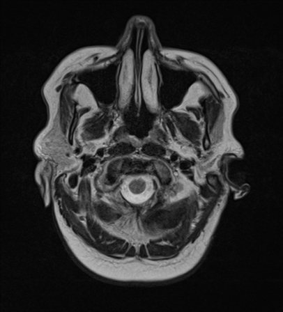 File:Cerebral metastases mimicking abscesses (Radiopaedia 45841-50131 Axial T2 3).png