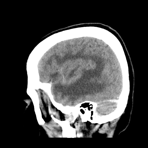 Cerebral metastasis to basal ganglia (Radiopaedia 81568-95412 Sagittal C+ delayed 14).png