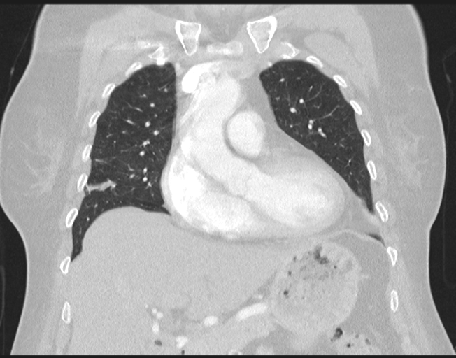 File:Cerebral metastasis to basal ganglia (Radiopaedia 81568-95414 Coronal lung window 33).png
