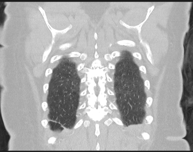 File:Cerebral metastasis to basal ganglia (Radiopaedia 81568-95414 Coronal lung window 72).png