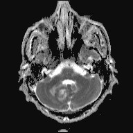 File:Cerebral toxoplasmosis (Radiopaedia 43956-47461 Axial ADC 4).jpg