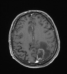 Cerebral toxoplasmosis (Radiopaedia 43956-47461 Axial T1 C+ 55).jpg