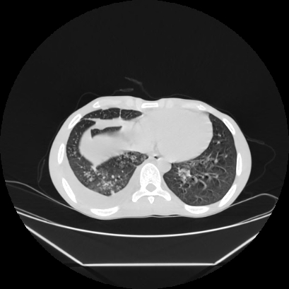 Cerebral tuberculoma (Radiopaedia 80829-94318 Axial lung window 135).jpg