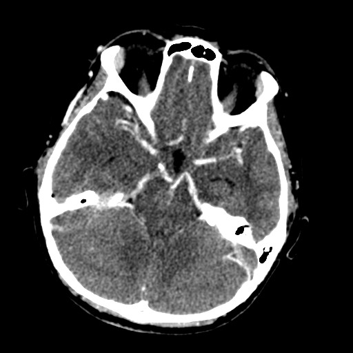 Cerebral tuberculosis with dural sinus invasion (Radiopaedia 60353-68019 Axial C+ delayed 20).jpg