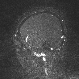 Cerebral tuberculosis with dural sinus invasion (Radiopaedia 60353-68090 Sagittal MRV 23).jpg
