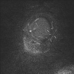 Cerebral tuberculosis with dural sinus invasion (Radiopaedia 60353-68090 Sagittal MRV 3).jpg