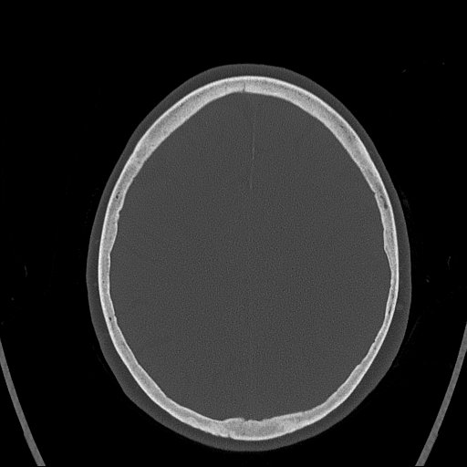 Cerebral venous infarction with hemorrhage (Radiopaedia 65343-74381 Axial bone window 134).jpg