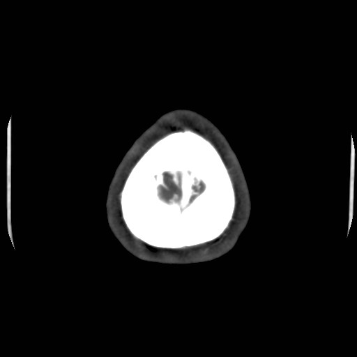 Cerebral venous sinus thrombosis (Radiopaedia 40619-43227 A 222).jpg