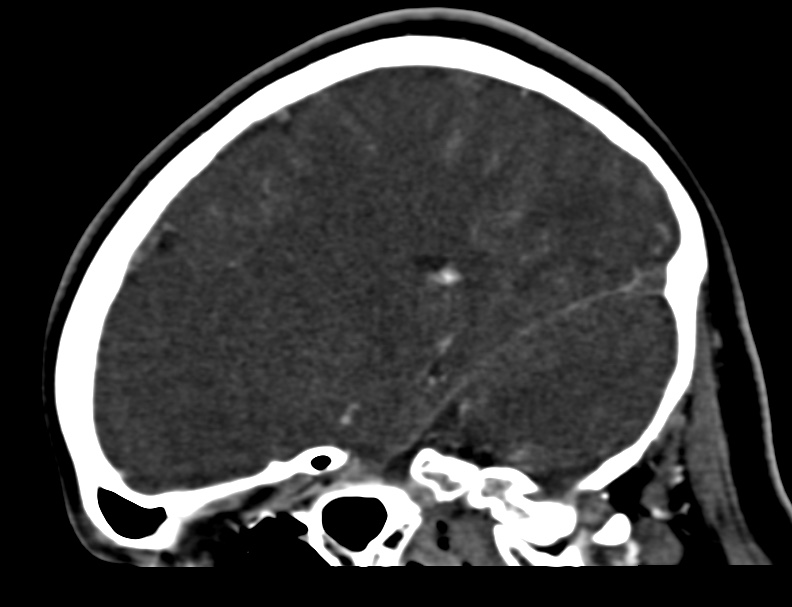 Cerebral venous sinus thrombosis (Radiopaedia 59224-66646 Sagittal C+ delayed 37).jpg
