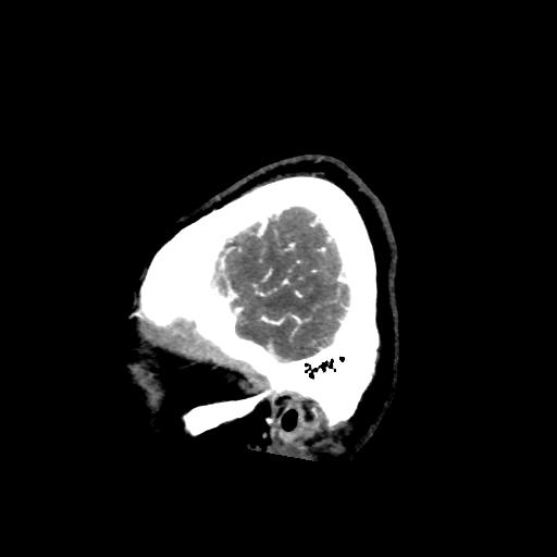 File:Cerebral venous throbmosis - hemorrhagic venous infarction (Radiopaedia 87318-103613 Sagittal CT venogram 1).jpg
