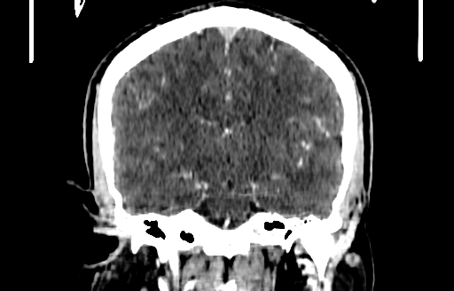 Cerebral venous thrombosis (CVT) (Radiopaedia 77524-89685 C 34).jpg