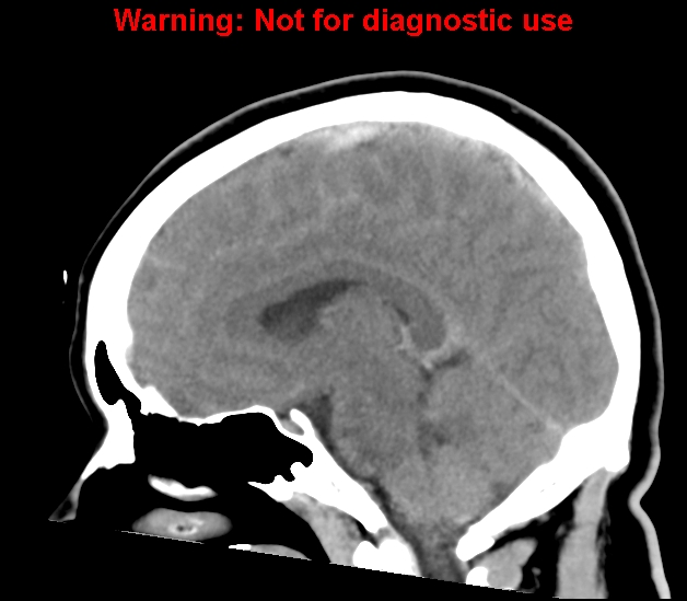 File:Cerebral venous thrombosis (Radiopaedia 37224-38992 B 15).jpg