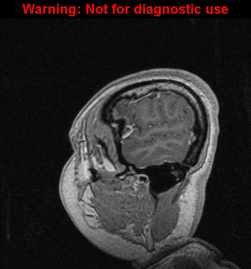 Cerebral venous thrombosis (Radiopaedia 37224-39208 Sagittal T1 C+ 19).jpg