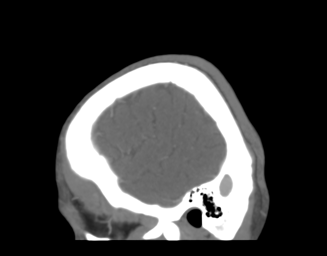 File:Cerebral venous thrombosis (Radiopaedia 38392-40467 D 47).png