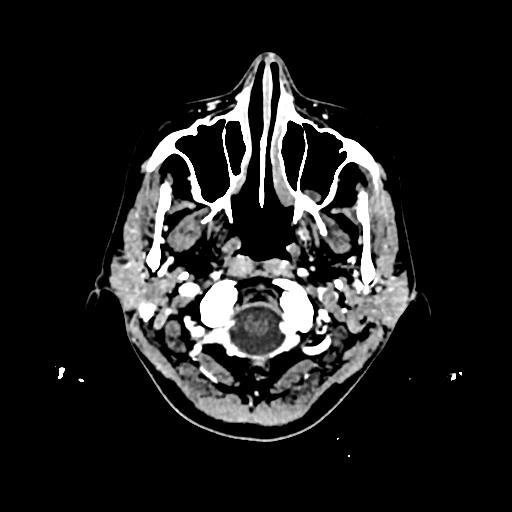 File:Cerebral venous thrombosis with venous hemorrhagic infarct (Radiopaedia 90354-107660 Axial with contrast 8).jpg