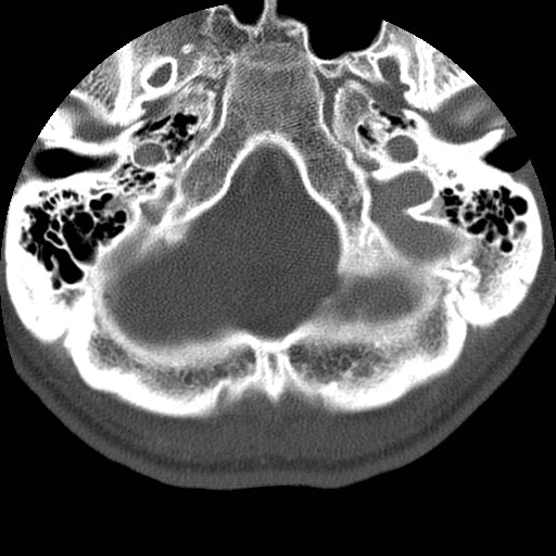 Cervical Pott disease (Radiopaedia 20374-20286 Axial bone window 2).jpg