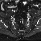 Cervical adenocarcinoma (Radiopaedia 65011-73985 Axial DWI 79).jpg