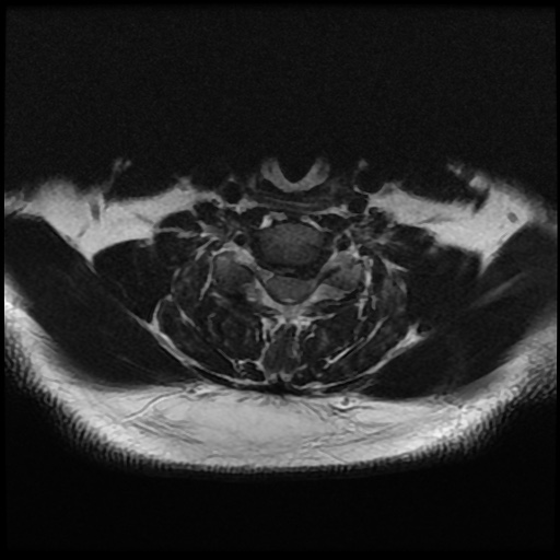 File:Cervical disc extrusion (Radiopaedia 59074-66364 Axial T2 12).jpg