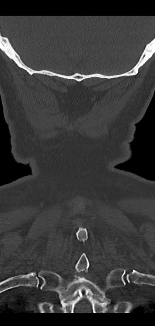 Cervical spine fracture - chalk stick (Radiopaedia 39116-41323 Coronal bone window 48).png