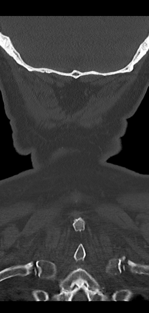 Cervical spine fracture - chalk stick (Radiopaedia 39116-41323 Coronal bone window 49).png